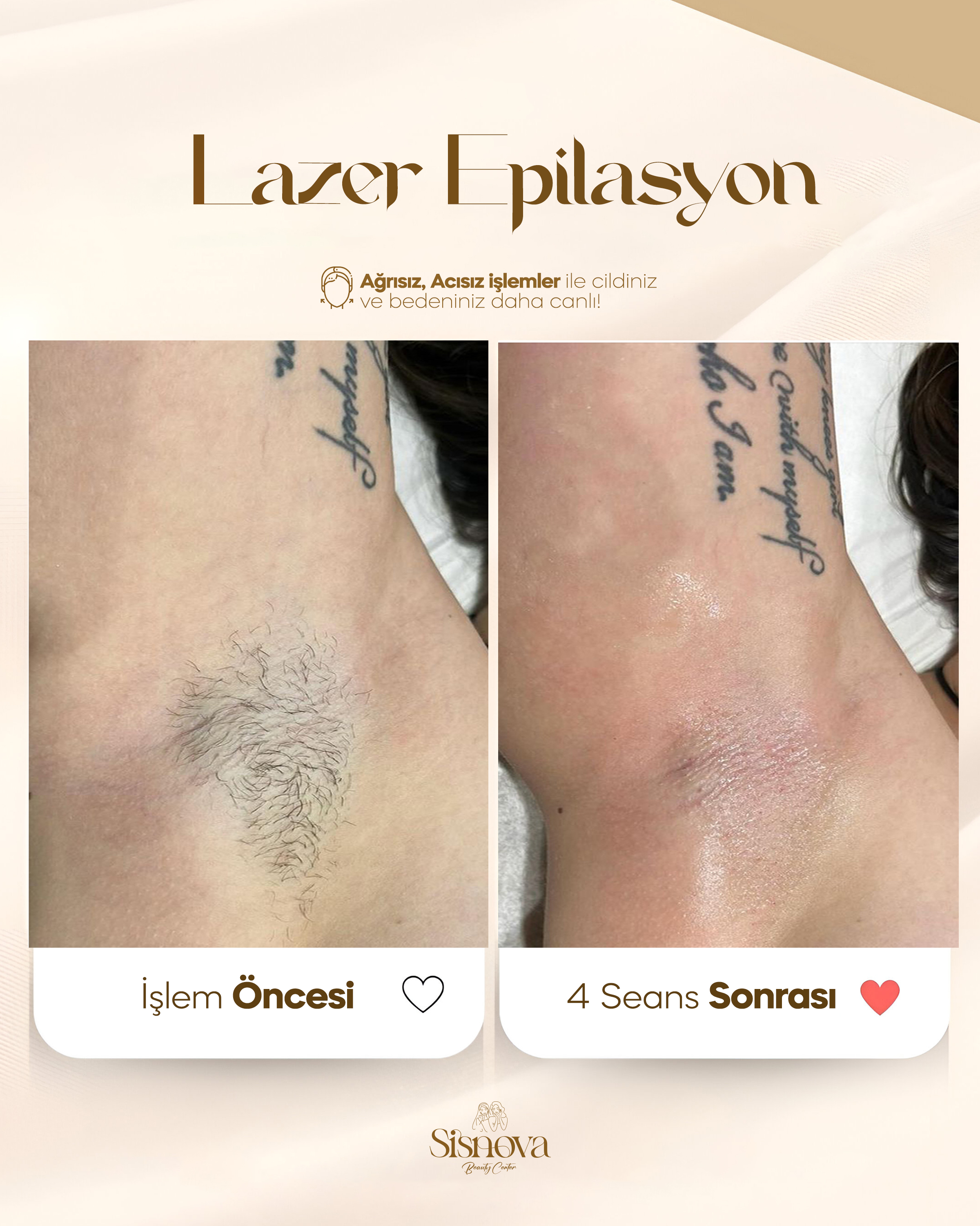 Lazer Epilasyon - Koltuk Altı Öncesi ve 4 Seans Sonrası