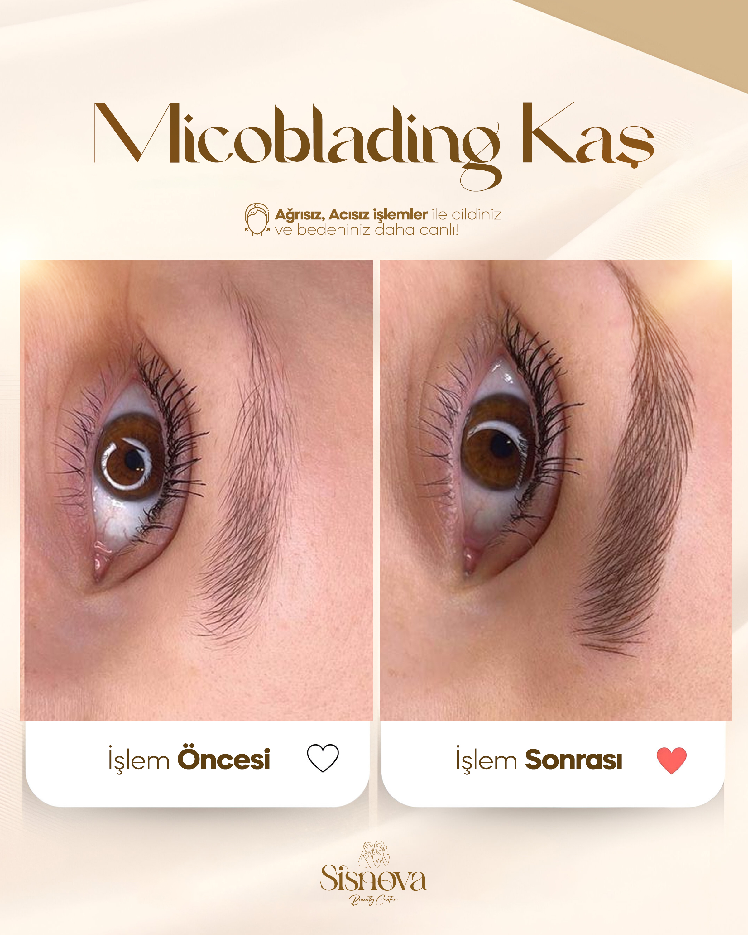 Lazer Epilasyon - Bacak Öncesi ve 4 Seans Sonrası