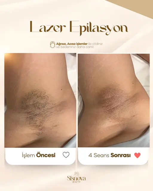 Lazer Epilasyon – Koltuk Altı Öncesi ve 4 Seans Sonrası