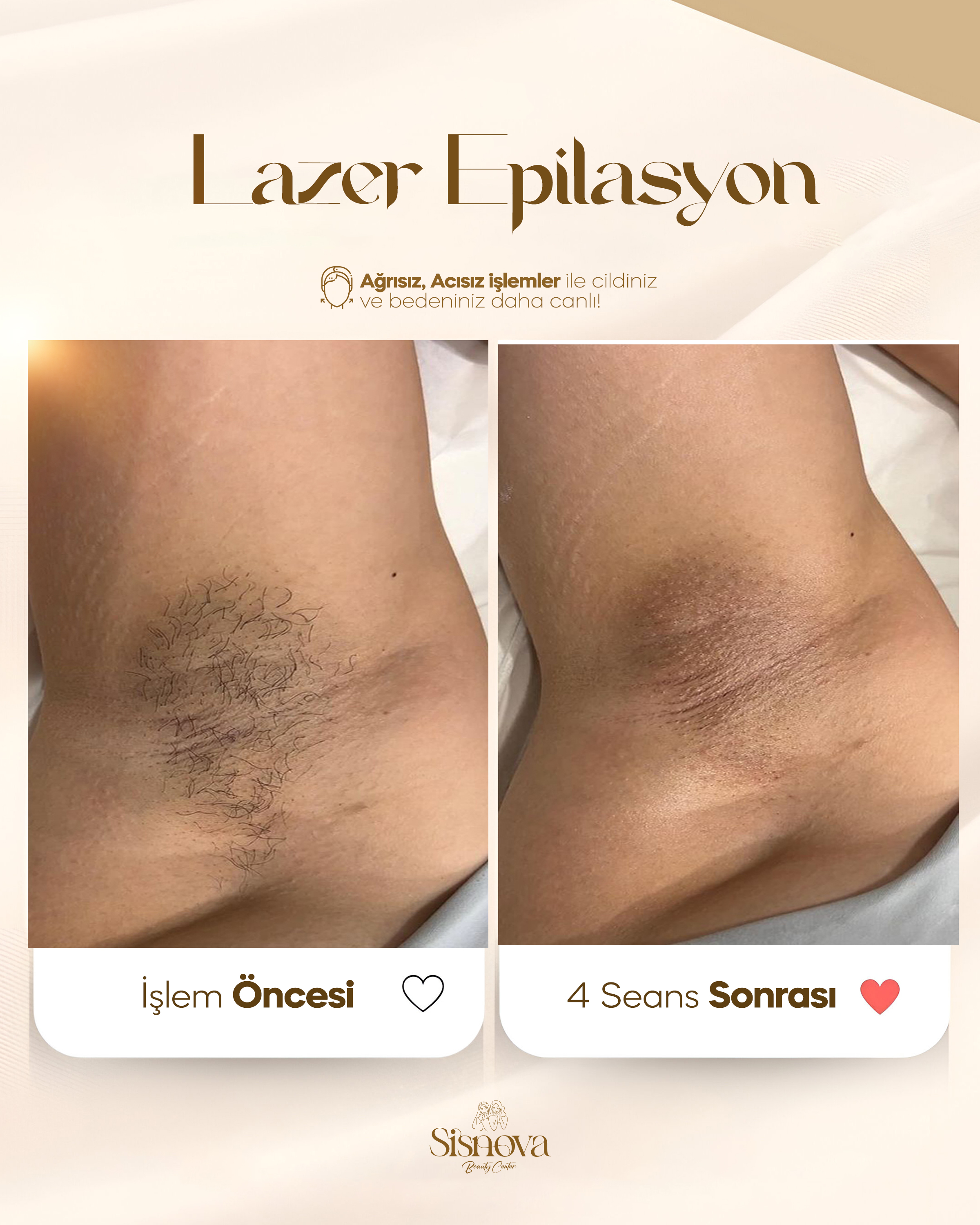 Lazer Epilasyon - Koltuk Altı Öncesi ve 4 Seans Sonrası