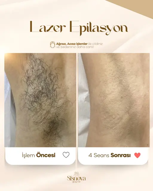 Lazer Epilasyon – Koltuk Altı Öncesi ve 4 Seans Sonrası