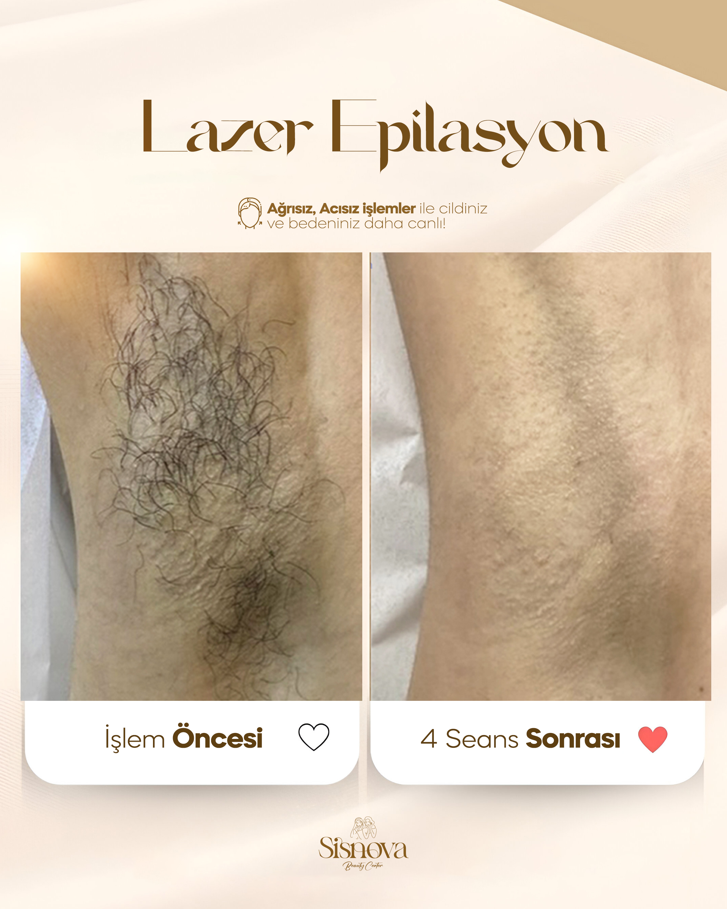Lazer Epilasyon - Bacak Öncesi ve 4 Seans Sonrası