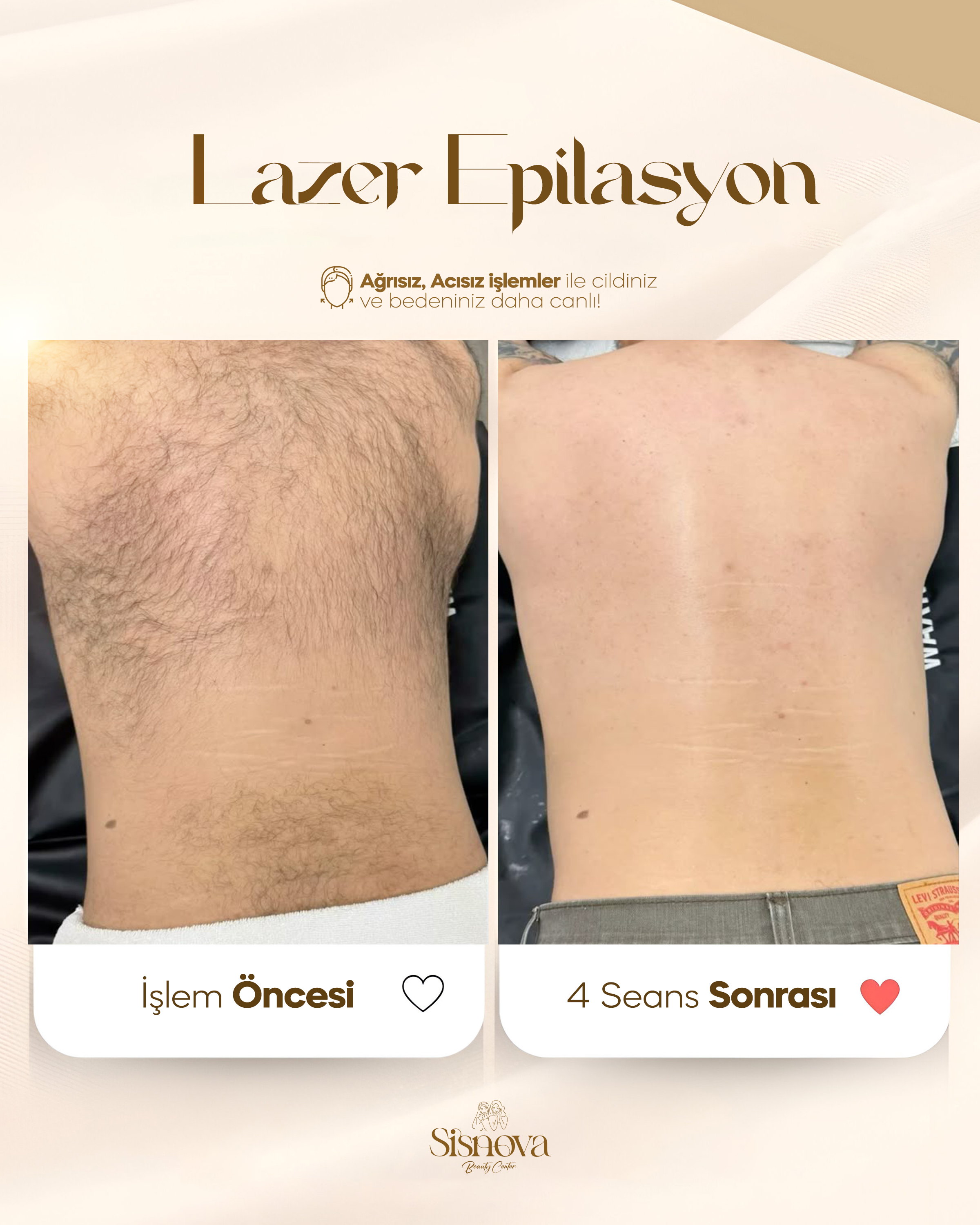 Lazer Epilasyon - Bacak Öncesi ve 4 Seans Sonrası