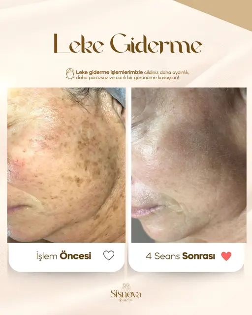 Leke Giderme – Yüz Öncesi ve 4 Seans Sonrası