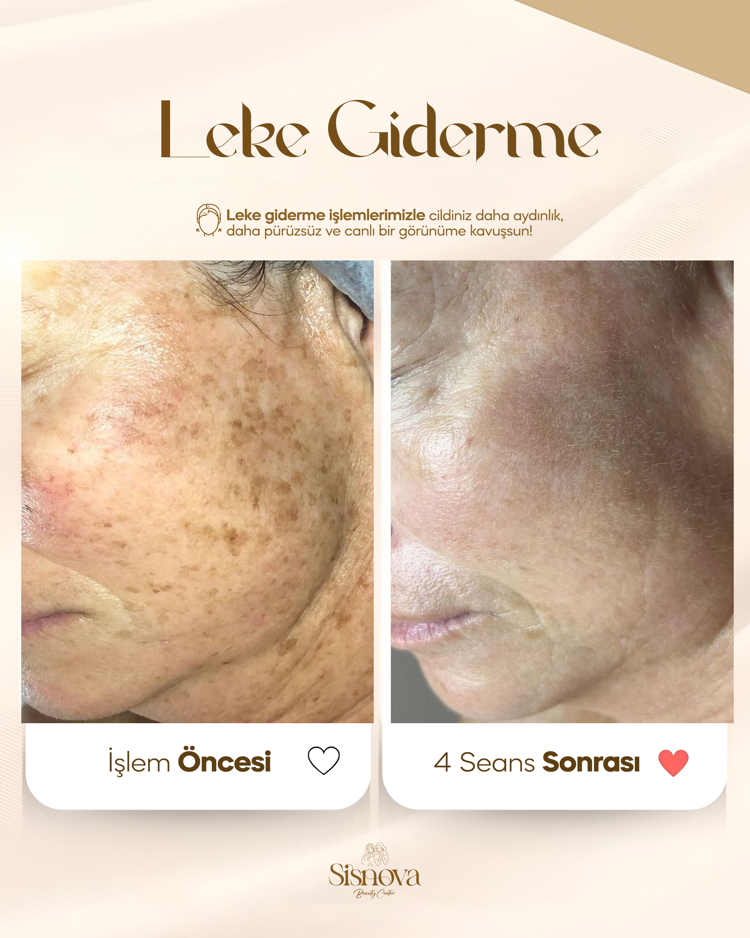Leke Giderme - Yüz Öncesi ve 4 Seans Sonrası