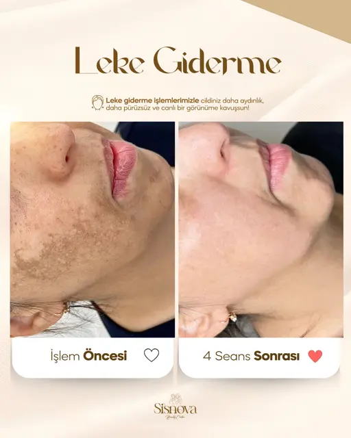 Leke Giderme – Yüz Öncesi ve 4 Seans Sonrası