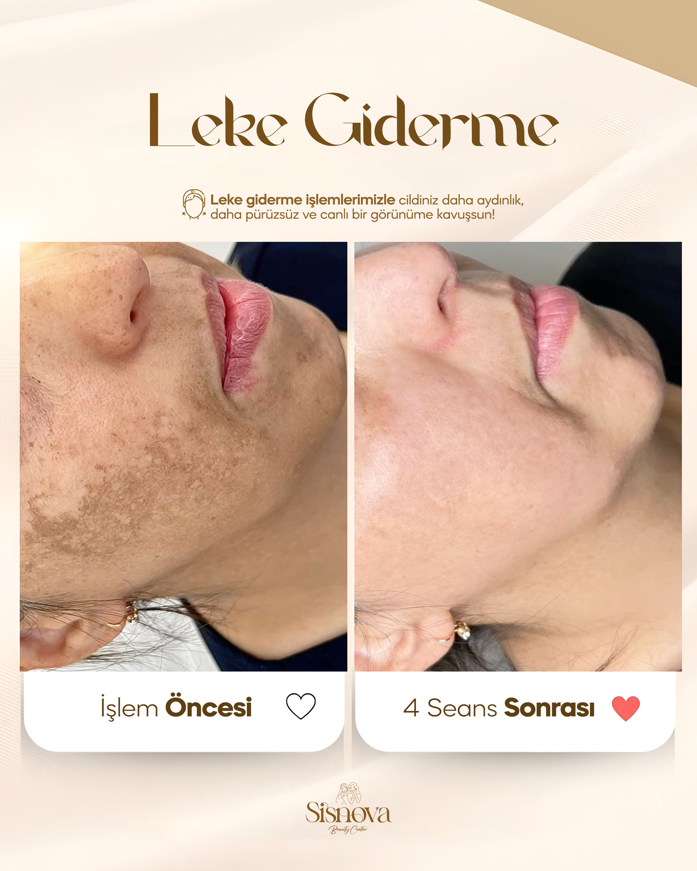 Leke Giderme - Yüz Öncesi ve 4 Seans Sonrası