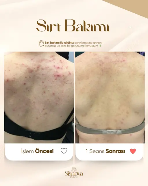Sırt Bakımı – Öncesi ve 1 Seans Sonrası