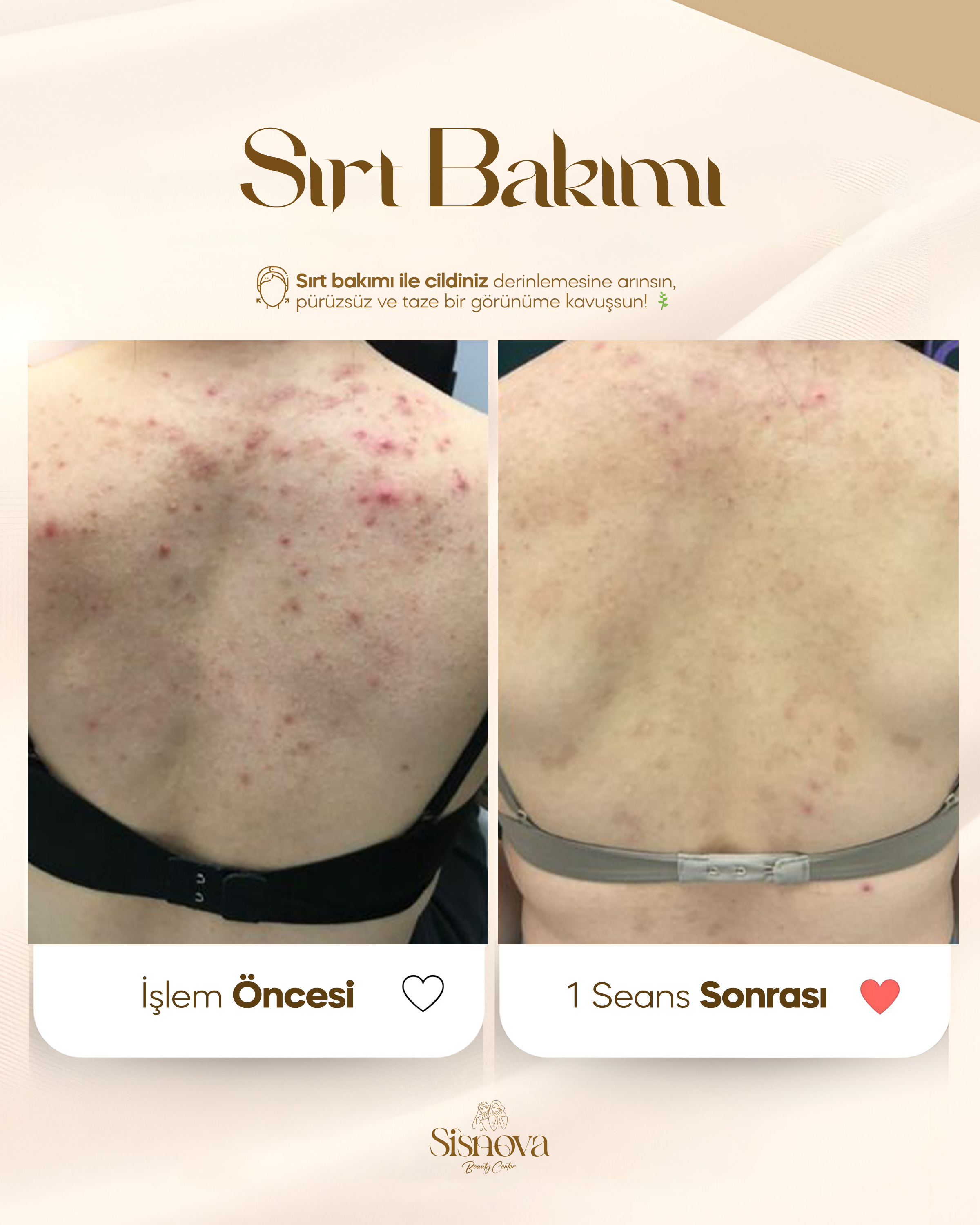 Sırt Bakımı - Öncesi ve 1 Seans Sonrası