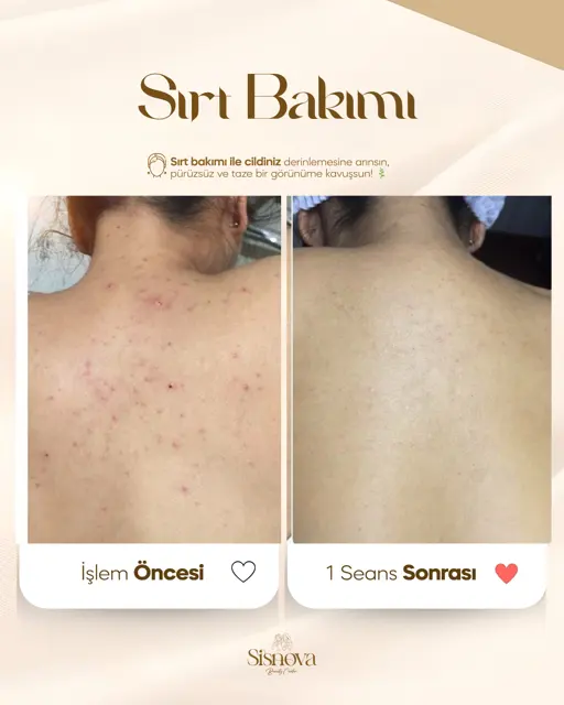 Sırt Bakımı – Öncesi ve Sonrası